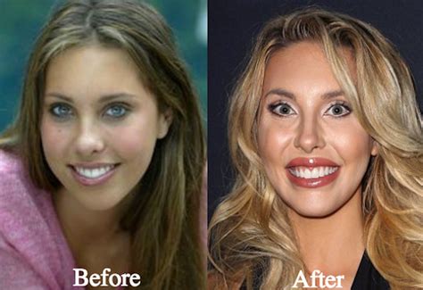 chloe latanzzi|chloe lattanzi before plastic surgery.